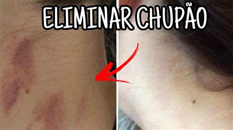 tirar chupada|Como tirar chupão: 8 truques simples para remover marcas na pele